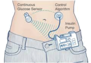 Glucose monitor & insulin pump
