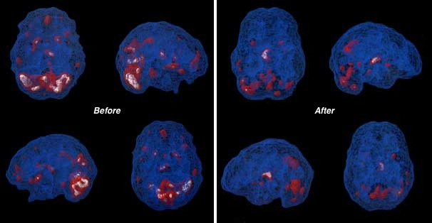 SPECT scans of PTSD sufferer before and after Neurofeedback