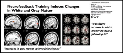 Neurofeedback Training Induces Changes in White and Gray Matter